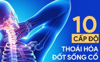 10 cấp độ thoái hóa đốt sống cổ: Hãy xem bạn bị mức mấy để xử lý trước khi bệnh nặng lên